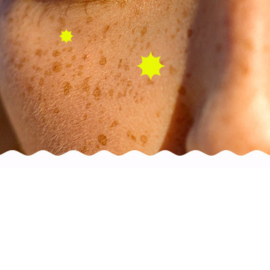 Pigmentation spots