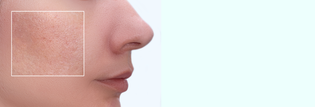 Taking care of oily skin